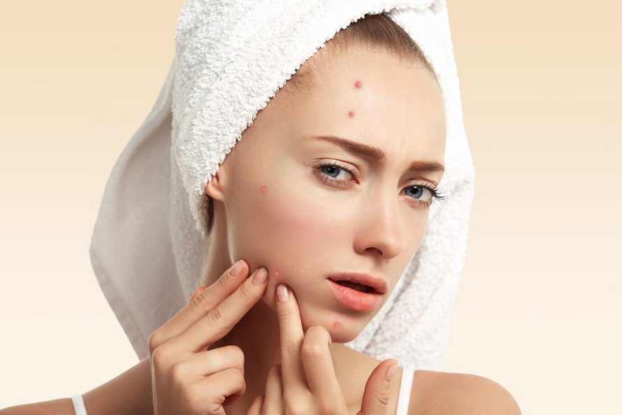 Acne Facial