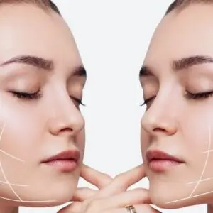Chin Contouring